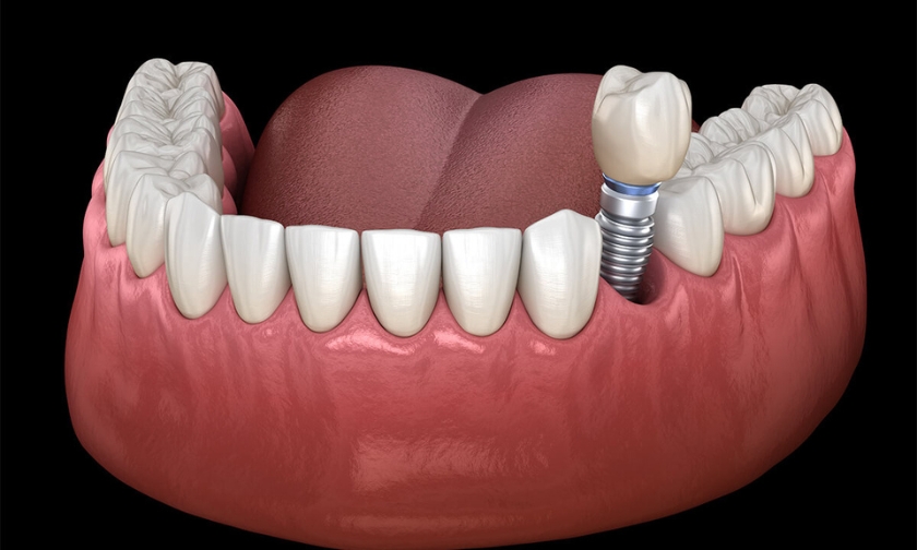 How Much Pain Can I Expect from Dental Implant Surgery