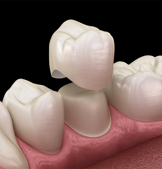 Dental Crowns In Alameda